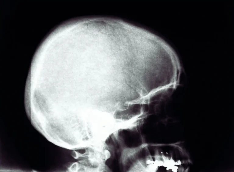 The x-ray of a skull.