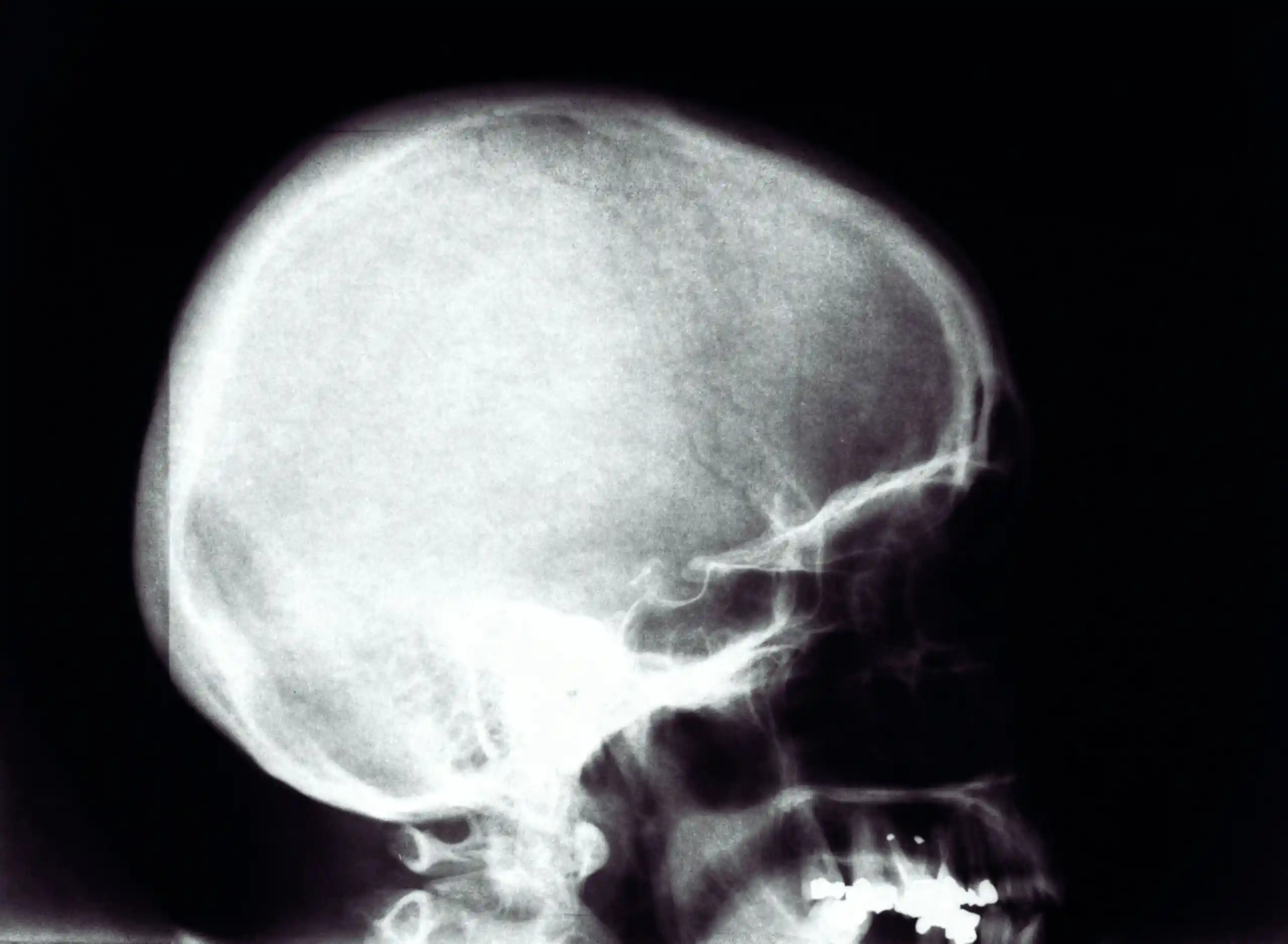 newington-spine-and-joint-concussion-subtypes
