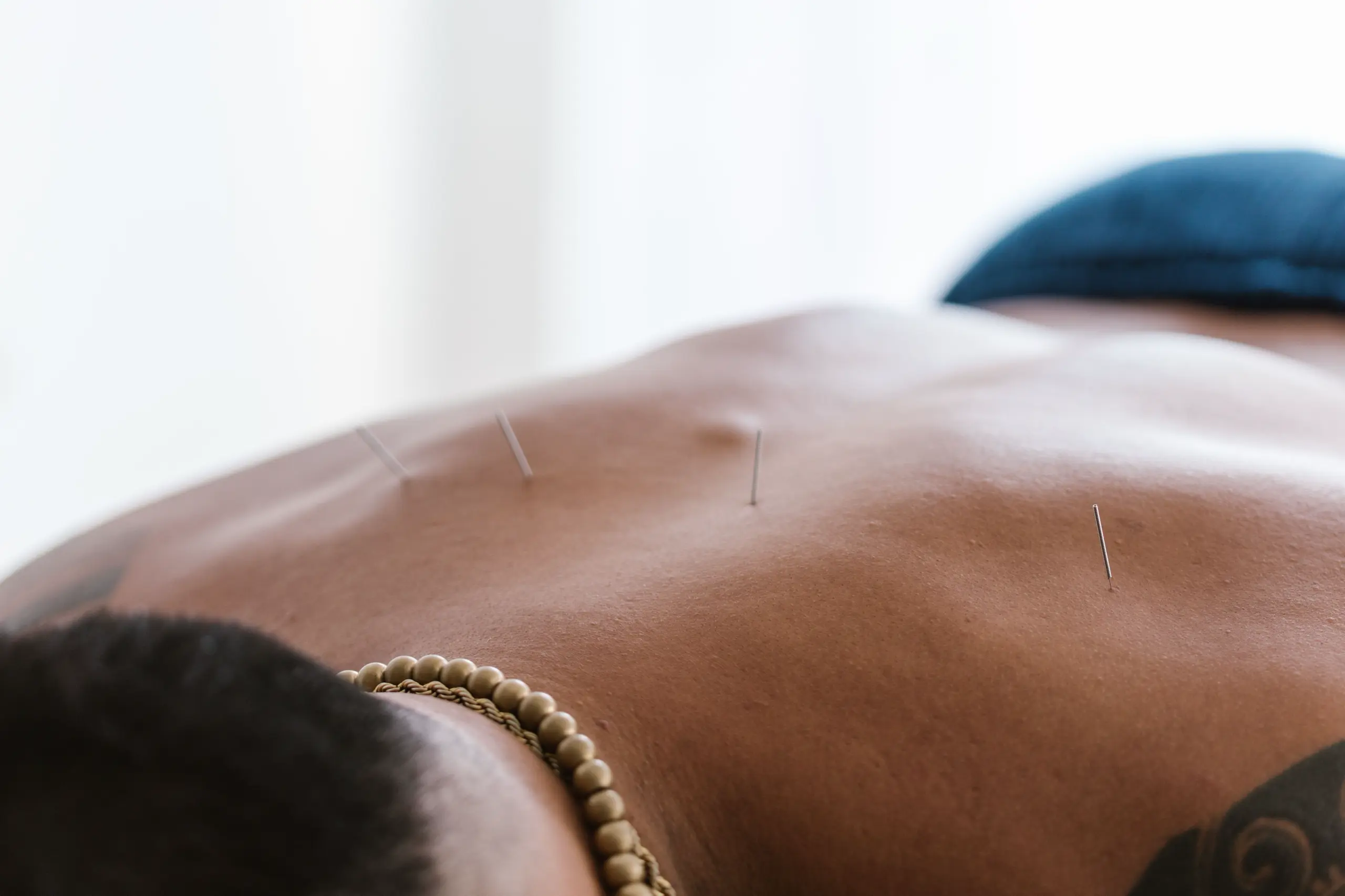 Trigger point dry needling for muscle pain relief.
