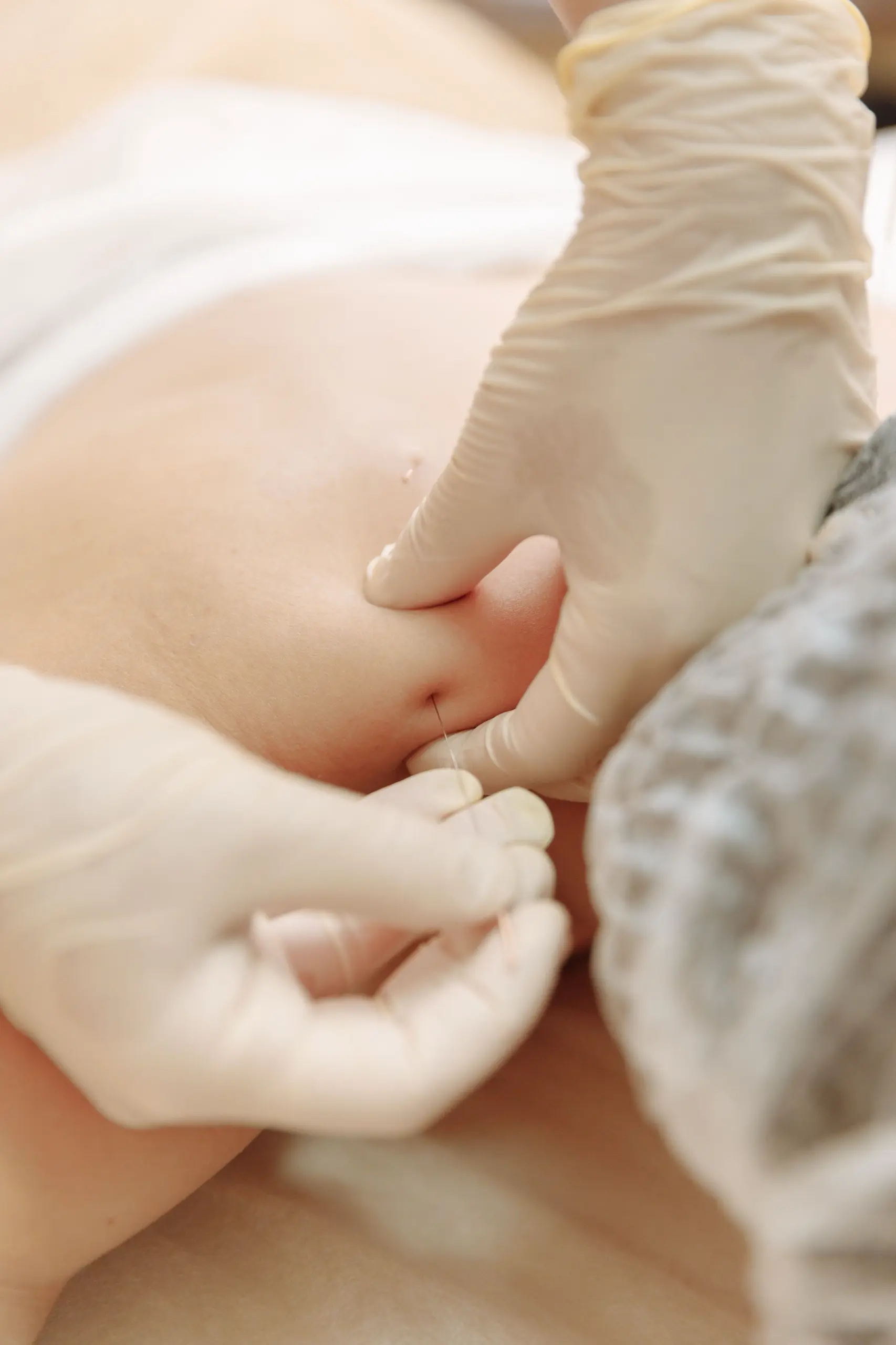 Trigger point dry needling for muscle pain relief.